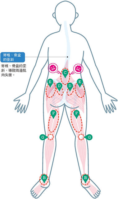 腰痛：抓捏阿基里斯腱、腰部筋膜