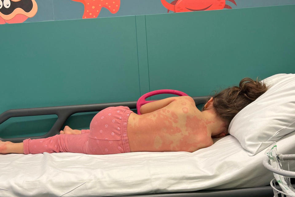 Nancy Ray developed a severe rash, which is a symptom of Strep A. (Kadie Dolphin/SWNS)