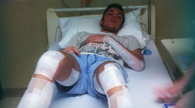 Heroic teenager Nathan Barry suffered serious burns in the boat explosion. Photo: Supplied