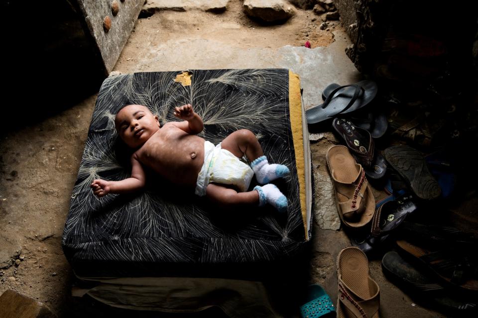 Ahee Bom lays on a cushion in the hallway of his home in Zanzibar. After birth, Ahee's skin began to significantly darken and peel off in large strips: Reuters