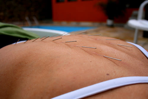 Artsy acupuncture needle design on mom's back