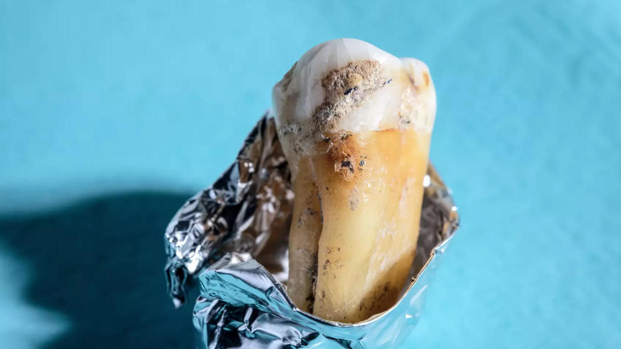  A preserved Neanderthal tooth partly wrapped in foil against a blue background. 