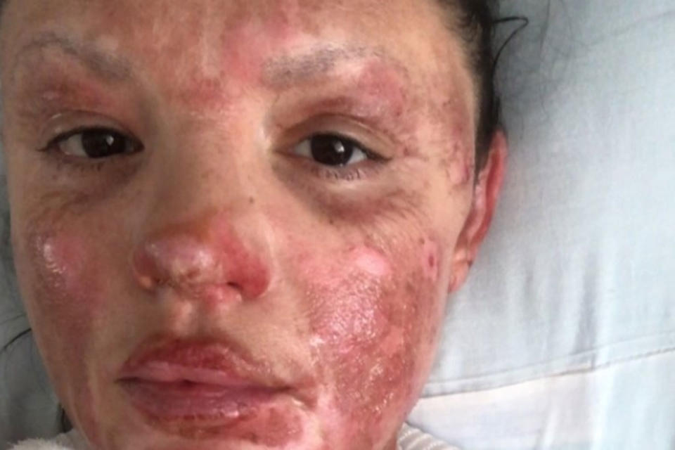 Rebecca Rogers' burnt face from an exploding barbecue.
