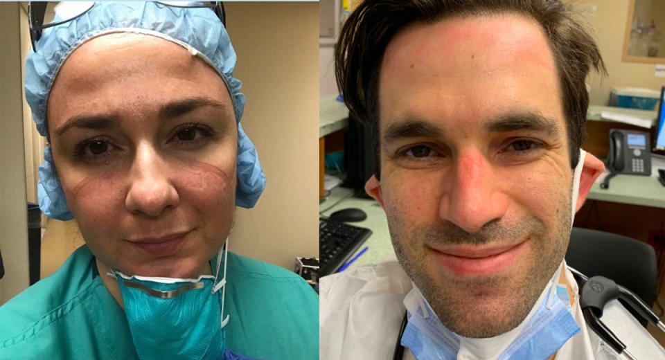 Nurse Cathy Nasso and Dr. Michael Taylor, New York City healthcare workers caring for covid-19 patients, with sore, red skin and ulcers from wearing PPE during long, back-to-back hospital shifts. (Photos: Courtesy of Rosalee Nasso and Karen Ambert)