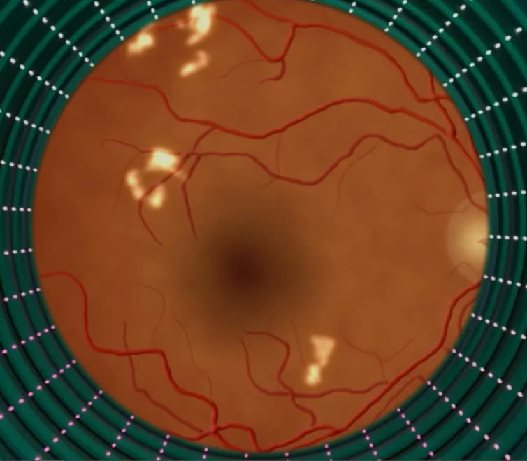 Programas de inteligencia artificial diagnostican retinopatía diabética en minutos