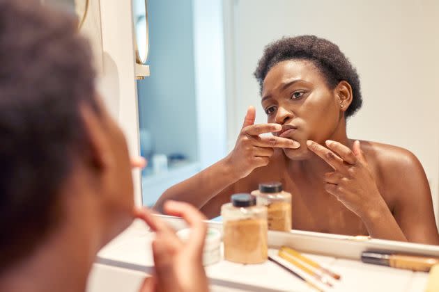 Putting toothpaste on your zit may be better than popping it, but aestheticians still don't recommend it. (Photo: LaylaBird via Getty Images)