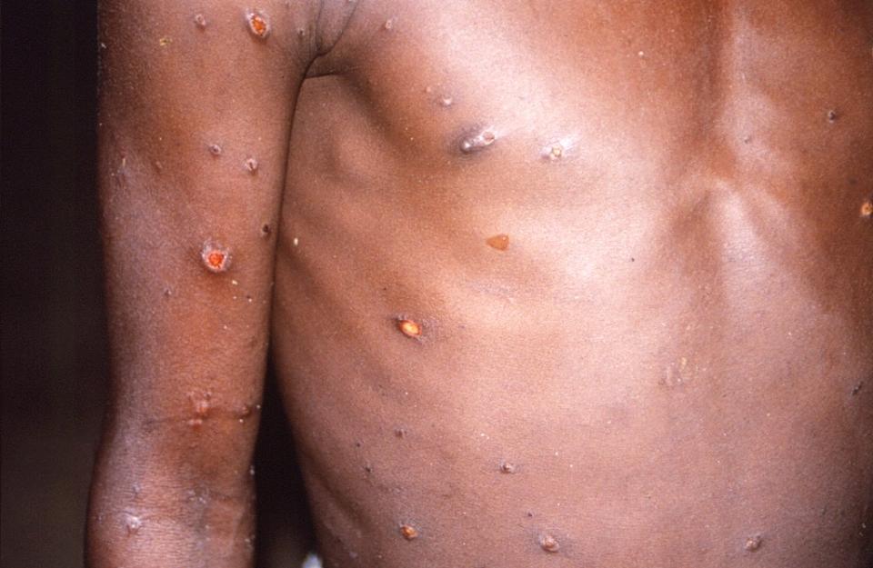 The right arm and torso of a patient overseas whose skin displays a number of lesions due to what had been an active case of monkeypox (CDC via AP) (AP)