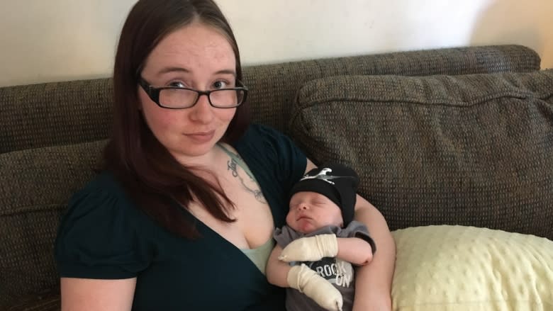 'It's really hard right now': Calgary couple struggles with infant son's rare skin disease