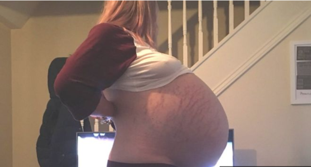 A woman in Wales found out through an ultrasound that what appeared to be a late-term pregnancy was actually a 57-pound cyst. (Image: HookNews/Keely Favell).