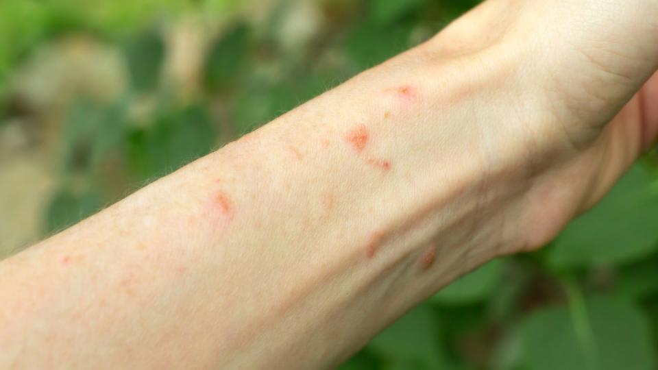 poison ivy rash on arm