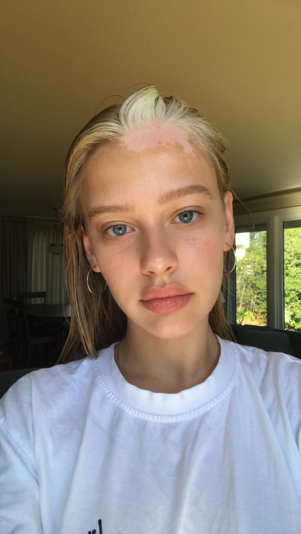 Porcelain skin, clear blue eyes, and a striking white streak on her forehead and in her hair: Meet Tia Jonsson, the 21-year-old model who embraces her vitiligo.