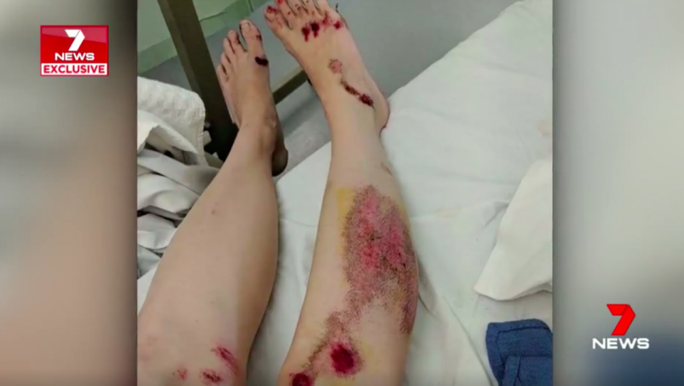 She suffered severe cuts to her feet, legs and arms. Source: 7News