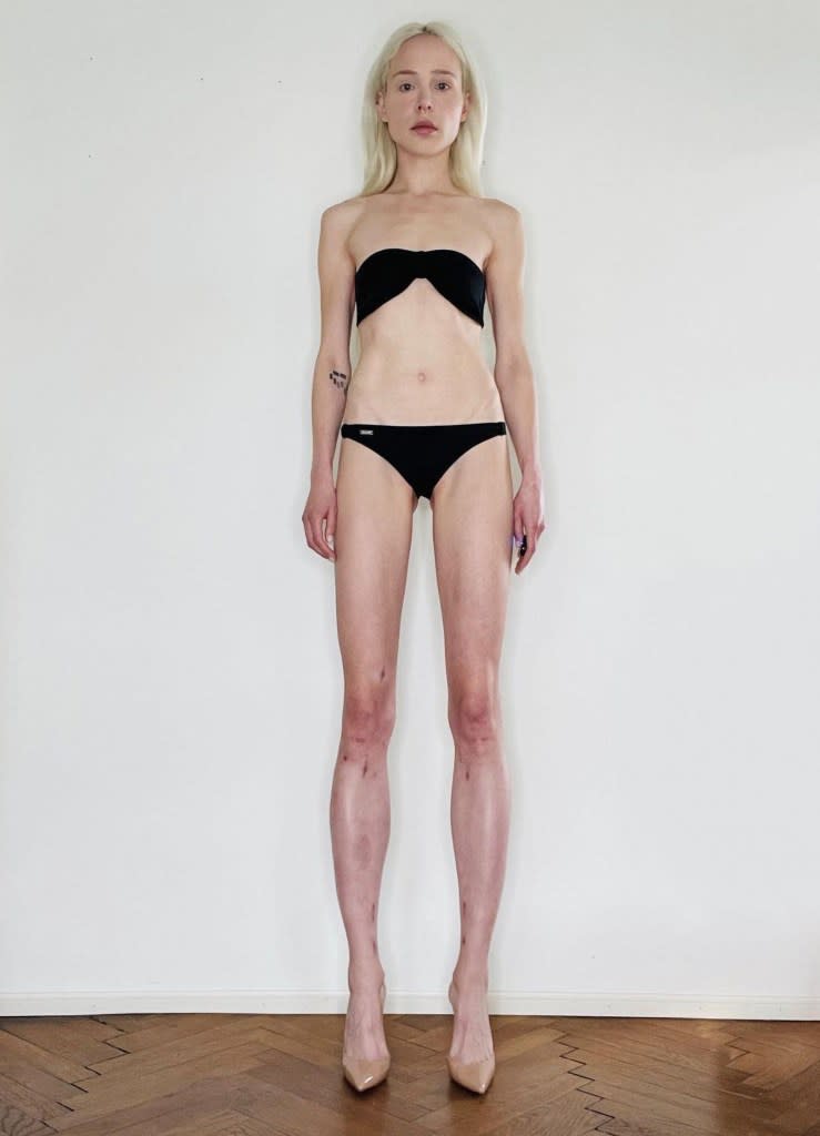 The model says her former husband vowed to always love her if she agreed to get the limb-lengthening surgery. CEN