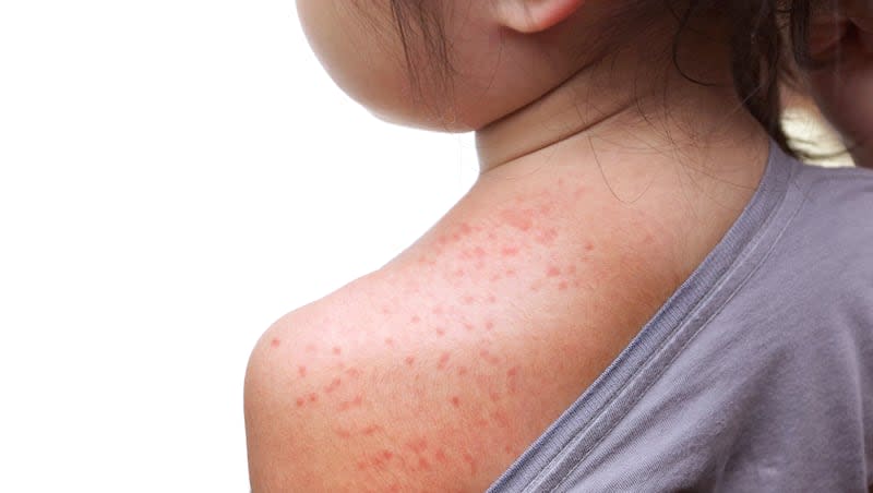 Utah‘s public health officials are concerned about the rising number of measles cases across the country, including in nearby Arizona.