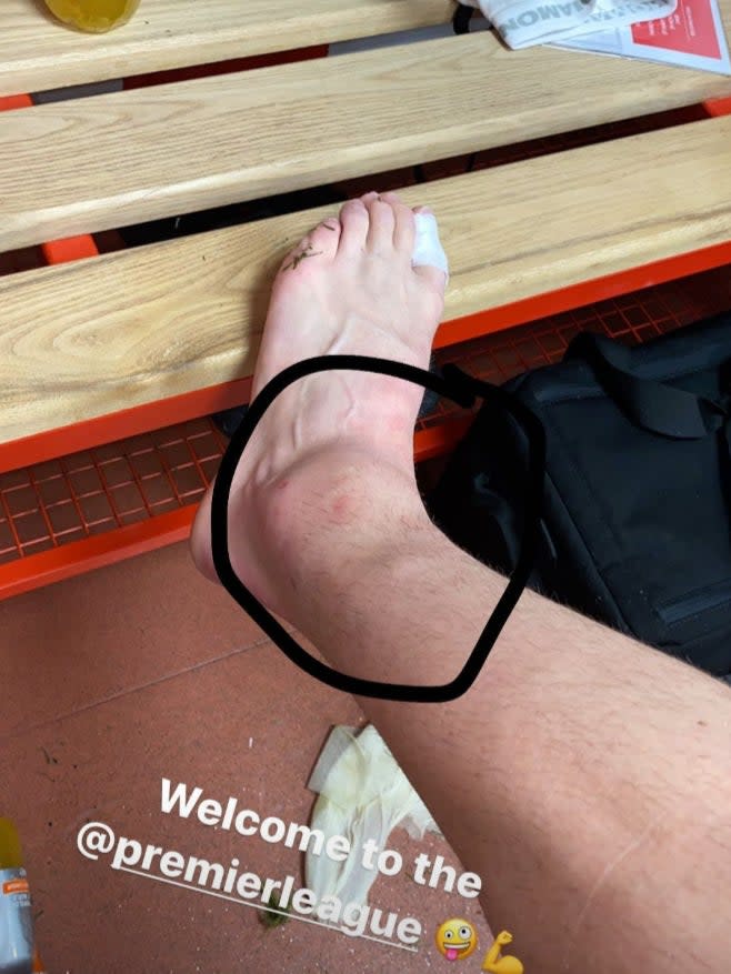 <p>Donny van de Beek posted a picture of his swollen ankle</p>Instagram/@donnyvdbeek