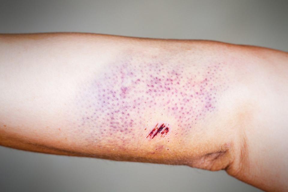 bruise on the skin petechiae
