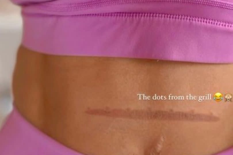 Stacey's scar on her stomach