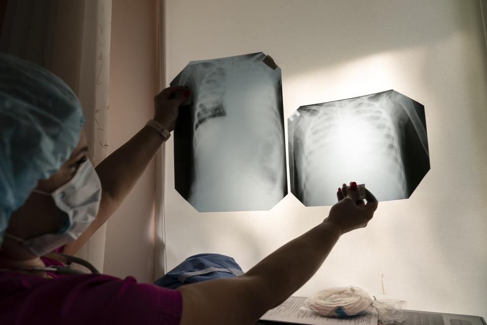 In this photo taken on Tuesday, May 5, 2020, a medical specialist, wearing a special suit to protect against coronavirus, checks a 5 years old girl's lung x-ray results at a hospital in Chernivtsi, Ukraine, Friday. Ukraine's troubled health care system has been overwhelmed by COVID-19, even though it has reported a relatively low number of cases. (AP Photo/Evgeniy Maloletka)