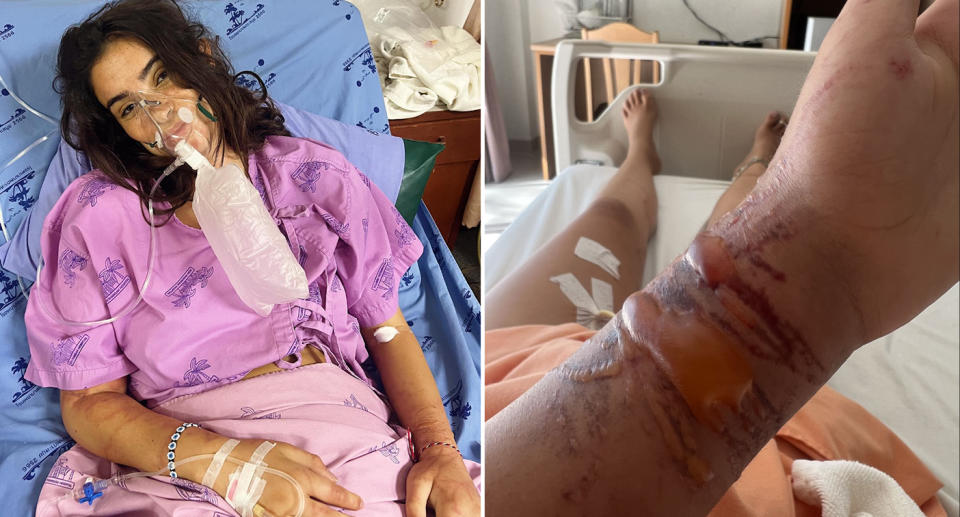 Left, Zoe Cahill in hospital with an oxygen mask on and scars on her hands. Right, huge welts and stings on Zoe's hand.