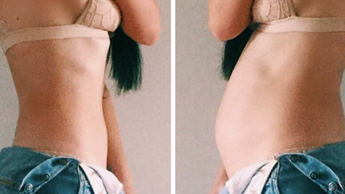 bloated belly before and after