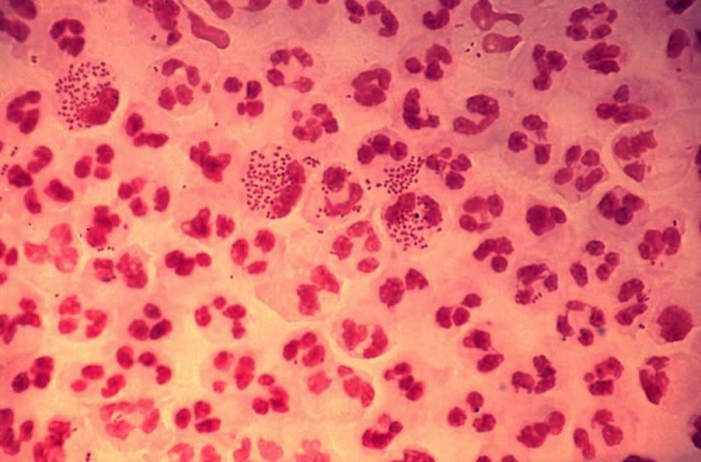 ‘Super gonorrhea’ is spreading.