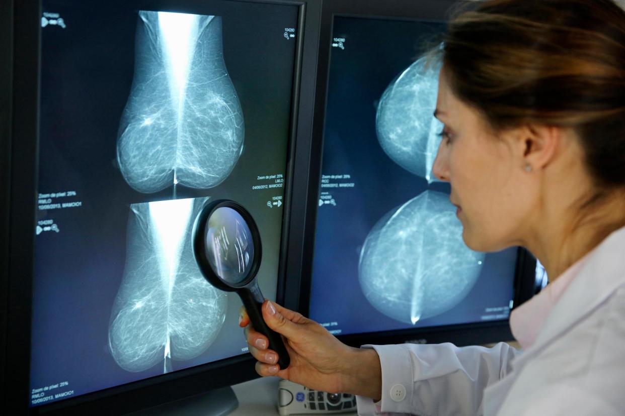 <span>Breast cancer, one of the most common types of cancer to afflict US women, kills an estimated 40,000 Americans each year.</span><span>Photograph: agefotostock/Alamy</span>