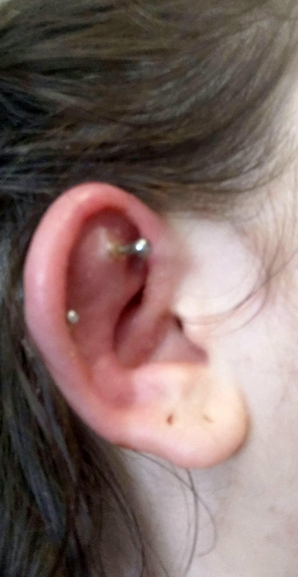 Stella Blezard's ear a few days after the piercing. (SWNS)