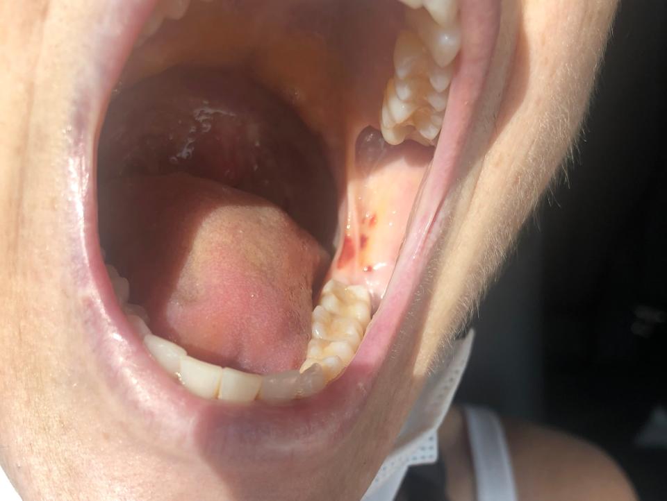 woman opening mouth, revealing cheek and tongue sores