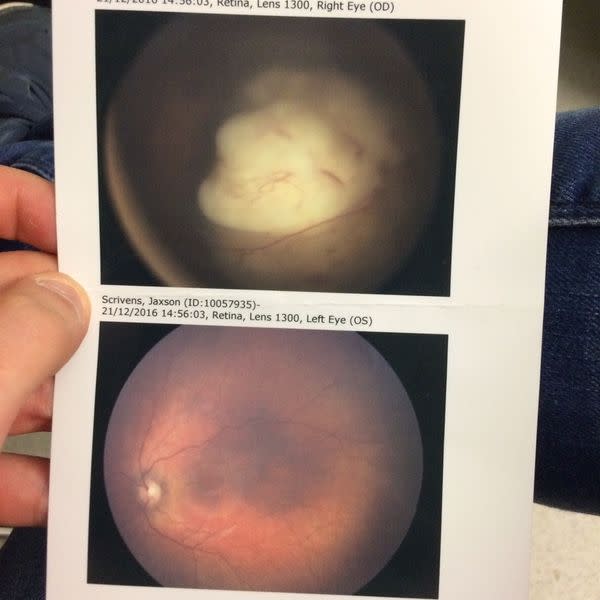 Les scans des yeux de Jaxson. Ils ont d’abord consulté un ophtalmologue qui leur a confié que Jaxson souffrait « probablement d’astigmatisme et aurait besoin de lunettes ». (Photo : GoFundMe)