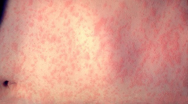 A measles alert has been issued in NSW. FIle pic. Source: Getty Images