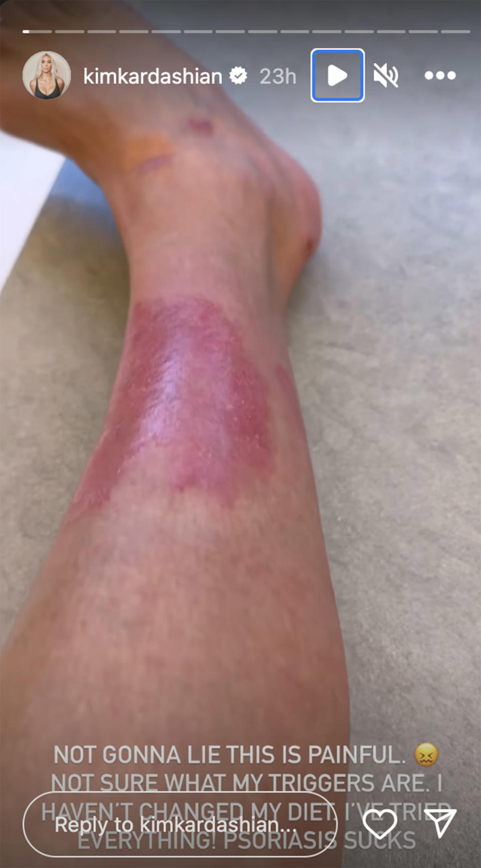 Kim Kardashian shares up close pics of her psoriasis and her hack for easing her symptoms (@kimkardashian via Instagram)