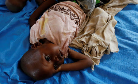 A severely acute malnourished and internally displaced Congolese child waits to receive medical attention at the Tshiamala general referral hospital of Mwene Ditu in Kasai Oriental Province in the Democratic Republic of Congo, March 15, 2018. Picture taken March 15, 2018. REUTERS/Thomas Mukoya