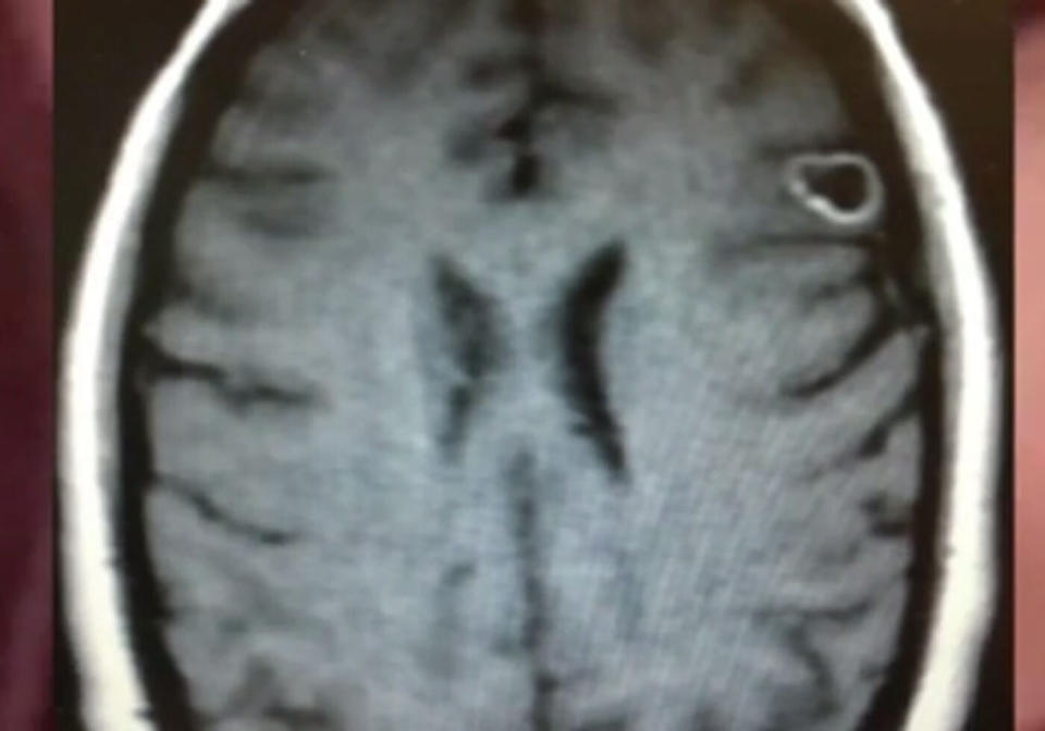 An X-ray of Rachel Palma's head shows her brain with a growth that looks like an egg in the front right part of the brain.