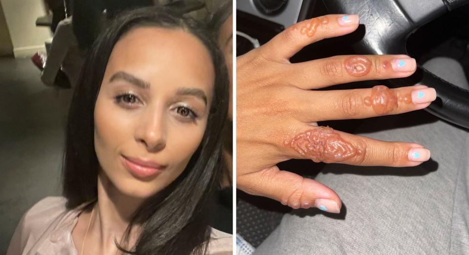 Laura Velaye had an allergic reaction to a 'henna' tattoo she had on holiday. (@lauraa_aura/Caters)