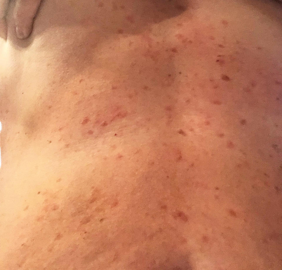 When Jill Zinsmeyer experienced temperature changes, she developed a brown splotchy rash that burned, a symptom of systemic mastocytosis, a rare condition impacting mast cells. (Courtesy Jill Zinsmeyer)