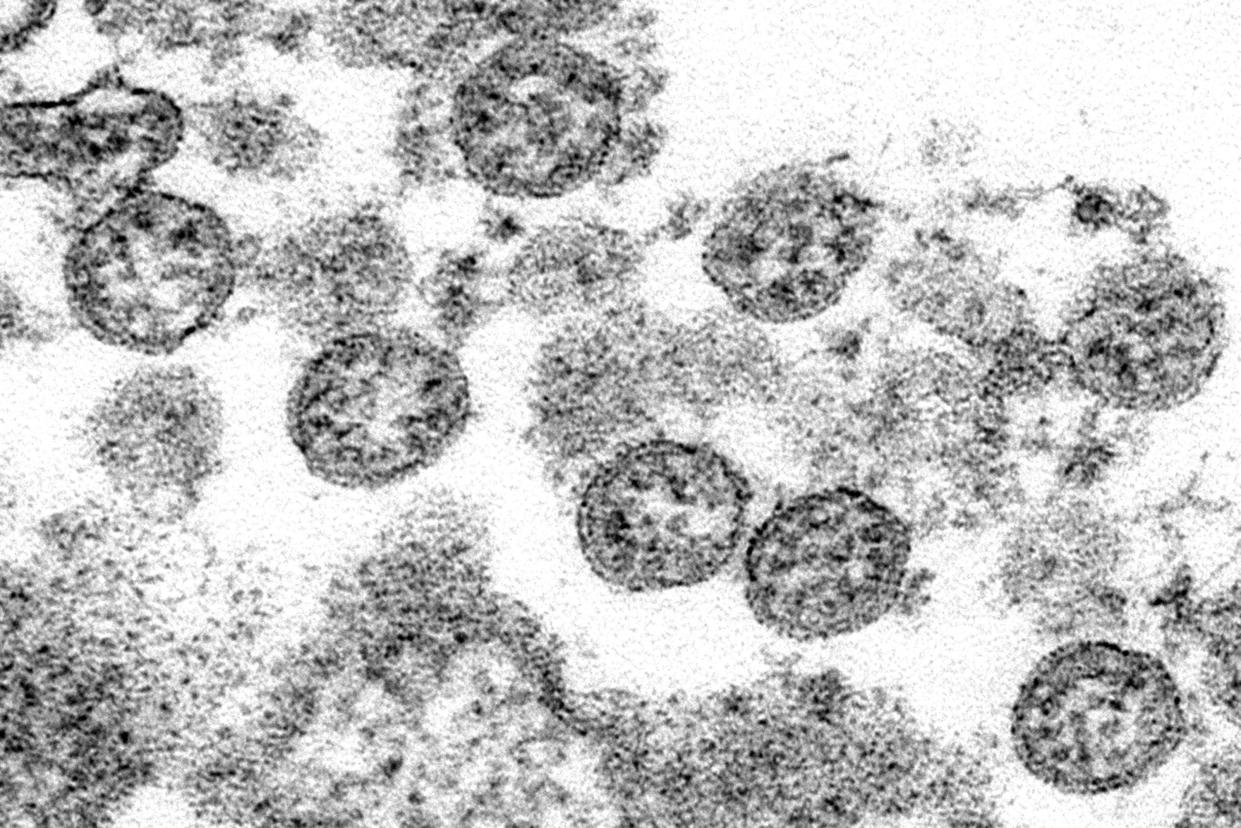 Spherical coronavirus particles, captured on an electron microscope, believed to be from the first case of Covid-19 in the US — new research suggests the virus could have reached America  earlier than previously thought (AP)