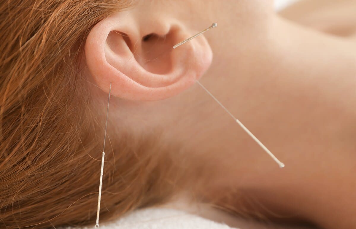 1200-ear-acupuncture.jpg