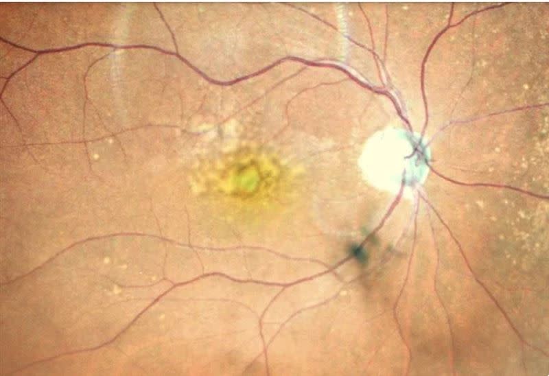 黃斑部有結疤組織，將影響中心視野，嚴重可能導致失明（圖／蔡景耀醫師提供）