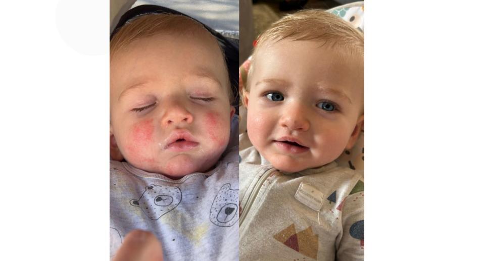 Before and after pictures of baby with eczema and after treatment