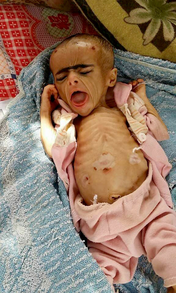 This 2018 handout image provided by Dr. Mekkiya Mahdi, Head of Aslam Health Center, shows a severely malnourished infant at the Aslam Health Center in Hajjah, Yemen. The situation in Aslam district is a sign of the holes in an international aid system that is already overwhelmed but is the only thing standing between Yemen’s people and massive death from starvation amid the country’s 3-year civil war. (Courtesy of Dr. Mekkiya Mahdi via AP)