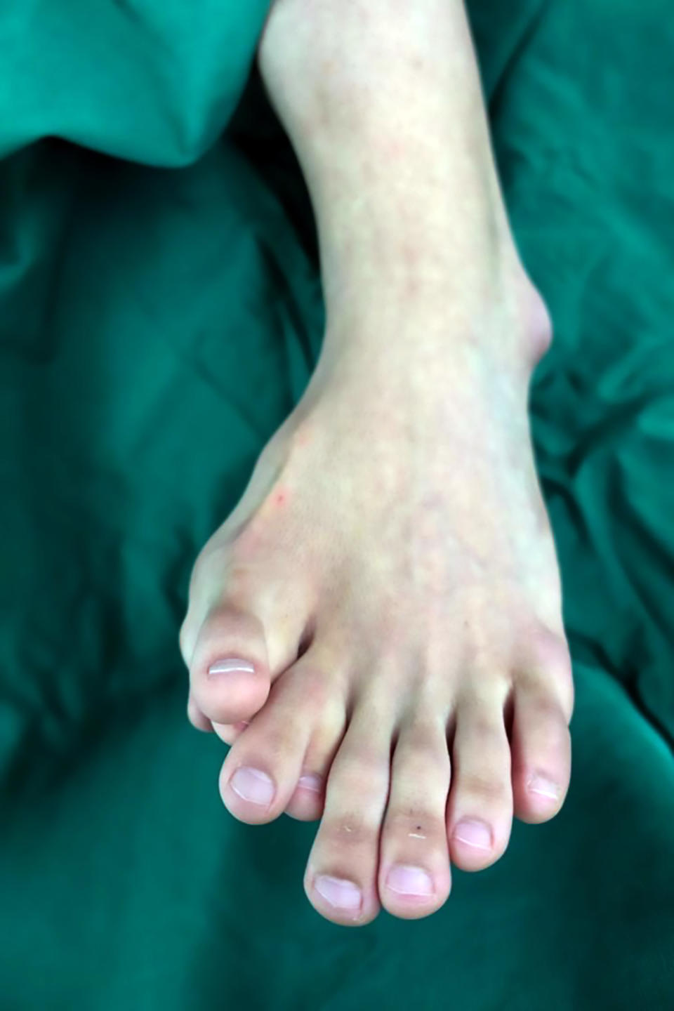 Pictured is Ajun's left foot, which has four extra toes. Source: Australscope.