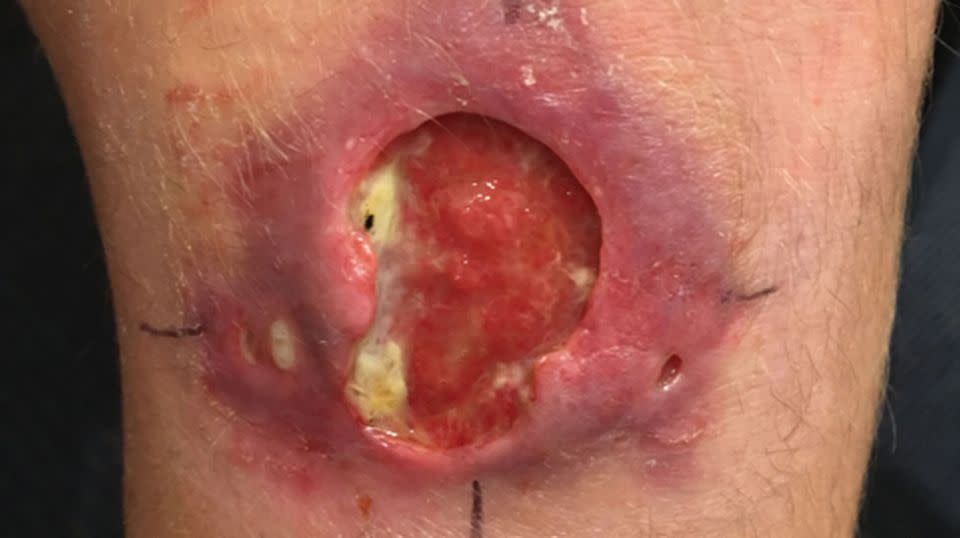 A severe Mycobacterium ulcerans lesion on the knee of an 11-year-old boy, a visitor to the Mornington Peninsula. Source: Medical Journal of Australia