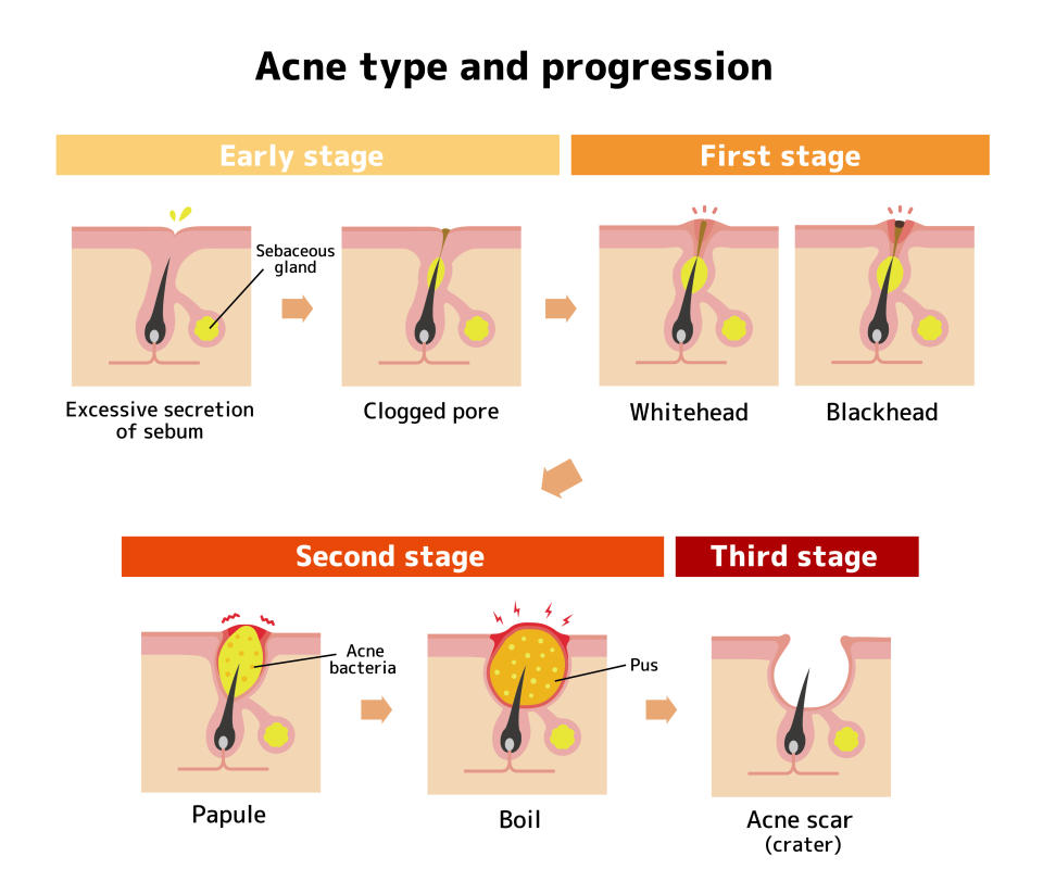 Acne types and progression illustration