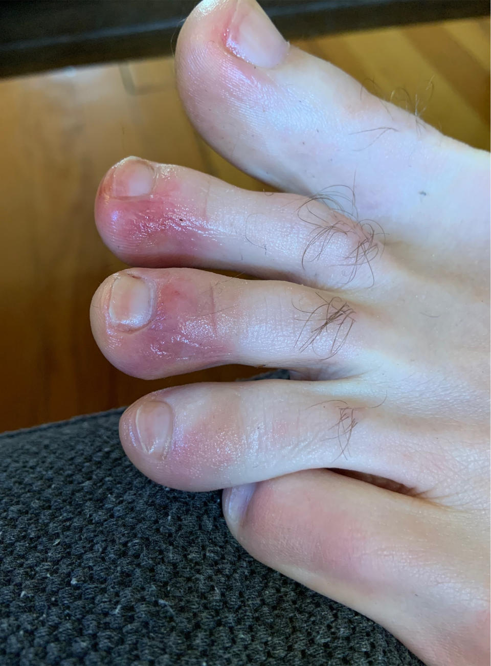 David, 39, said his condition, which appeared to be COVID toes, lasted for about a week. (Courtesy of David)