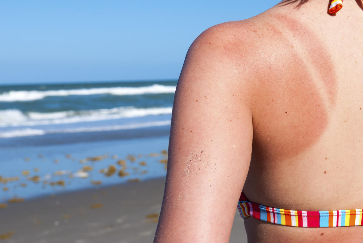 Skin cancer signs and symptoms. (Getty Images)