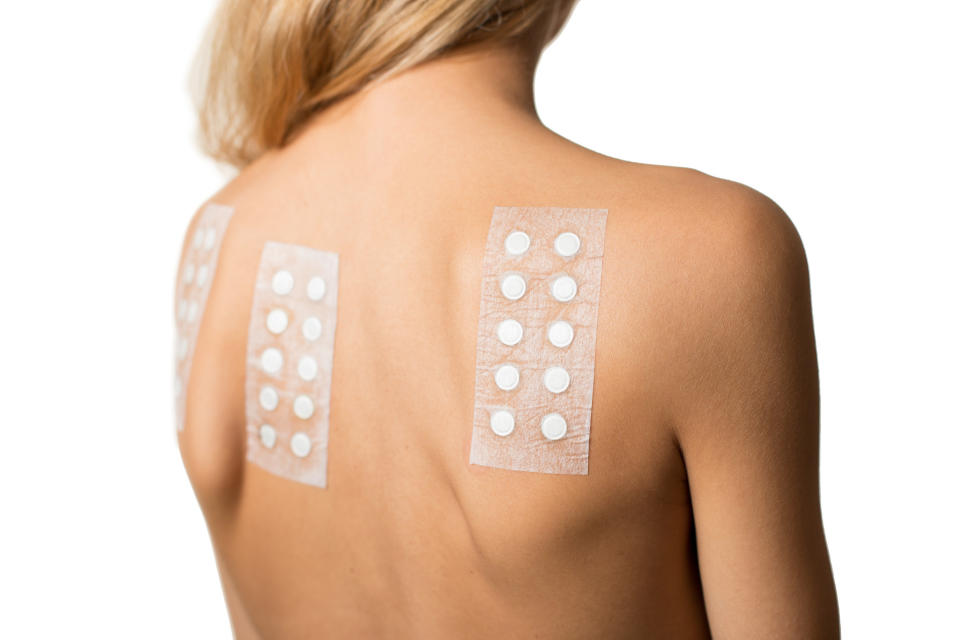 A woman getting patch tested on her back