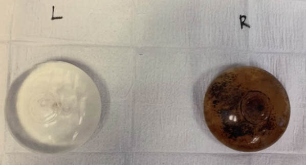 A clear breast implant (left) and a brown breast implant filled with mould (right).