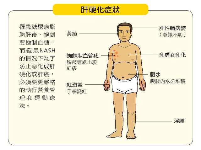 肝硬化症狀