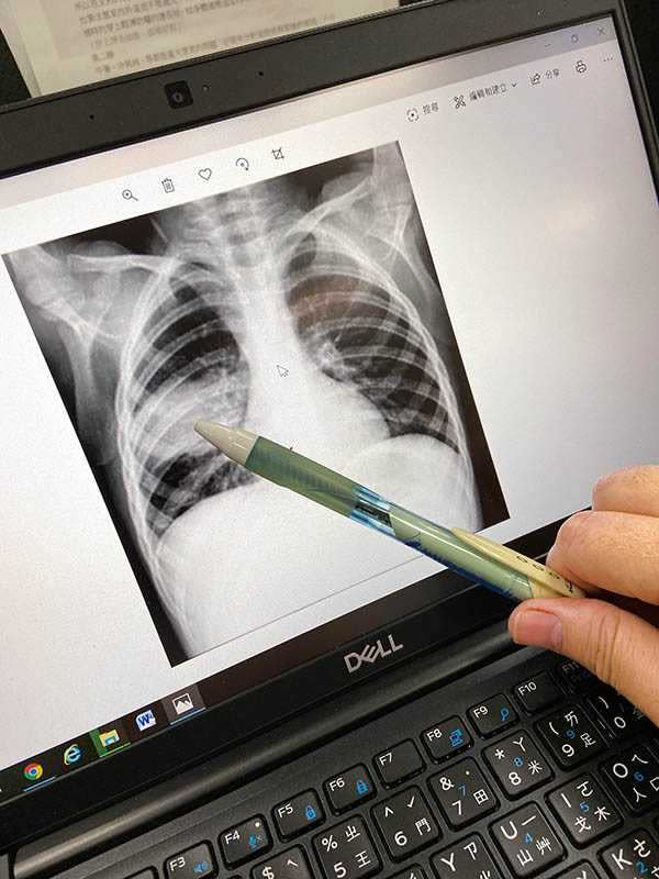 從黴漿菌肺炎患者的胸部X光片，可看出肺部呈現瀰漫性肺浸潤，即肺部局部發炎，造成肺間質組織水腫，沿著淋巴擴散。（圖／康宏銘醫師提供）