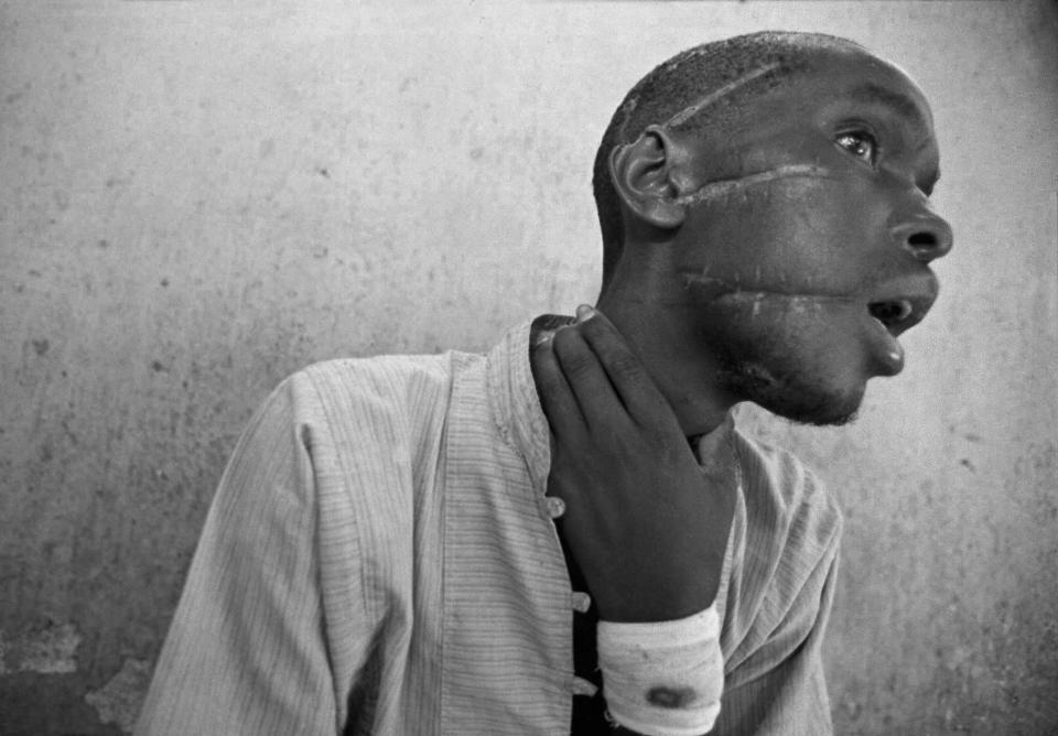 FILE - Nyabimana, 26, who was evacuated after being found by the Red Cross wandering in Kabgayi, shows his machete wounds at an International Committee of the Red Cross hospital in Nyanza, Rwanda, June 4, 1994. The massacres, mostly by machete-wielding gangs, swept across Rwanda where people were killed in their homes and farms, as well as in churches and schools where they sought shelter. (AP Photo/Jean-Marc Bouju, File)